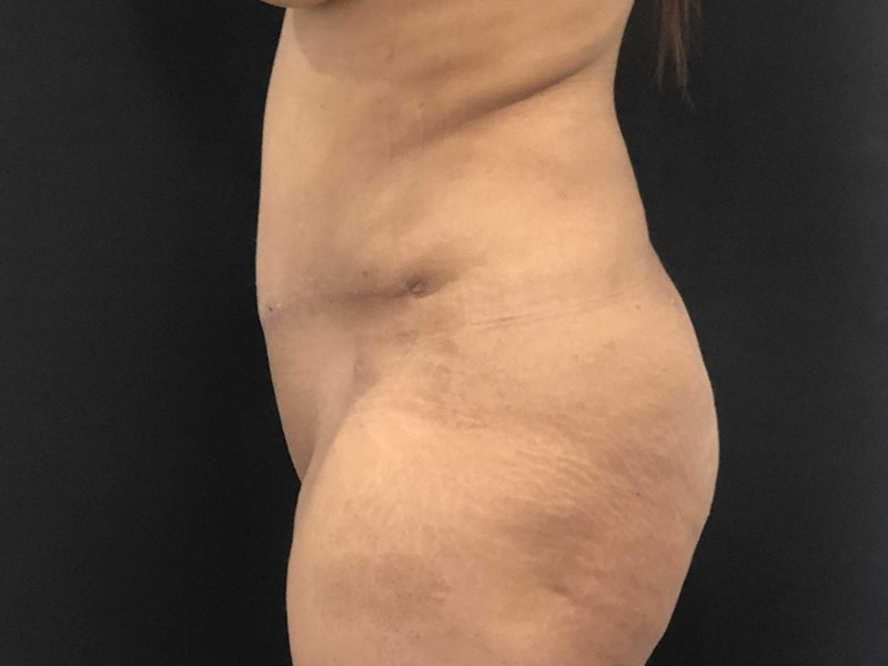 Tummy Tuck New Jersey Lateral After