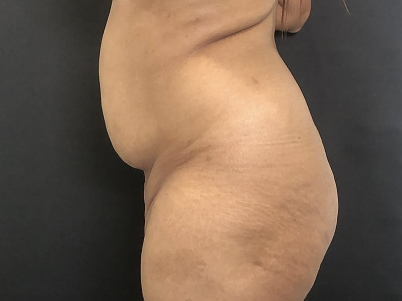 Tummy Tuck New Jersey Lateral Before