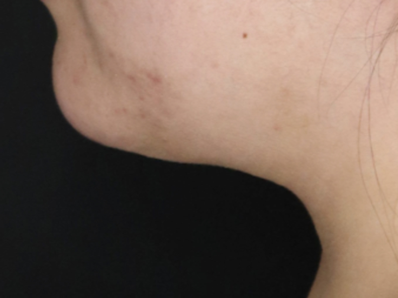 YK CHIN LIPO AFTER 2