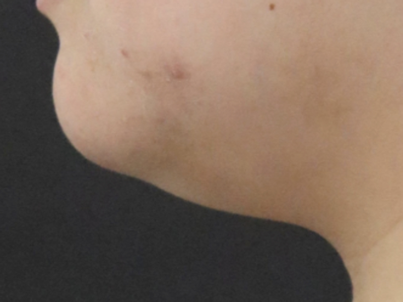 YK CHIN LIPO BEFORE 2