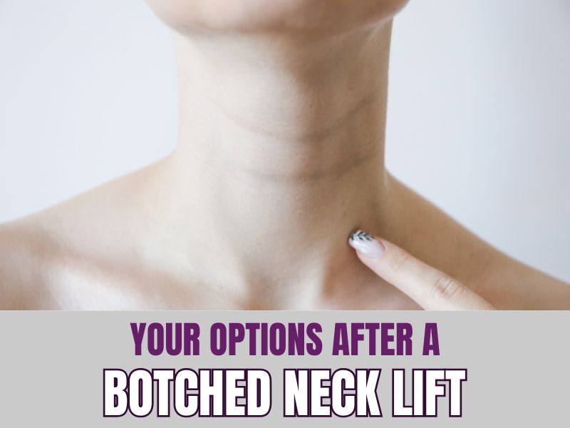 Your options after a Botched Neck Lift