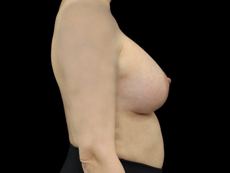 Breast Lift With Implant Patient 8 Lateral After