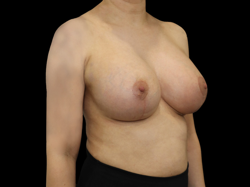 Breast Lift With Implant Patient 8 Oblique After