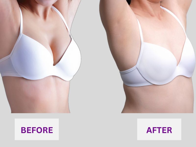 before and after photos of breast implant revision