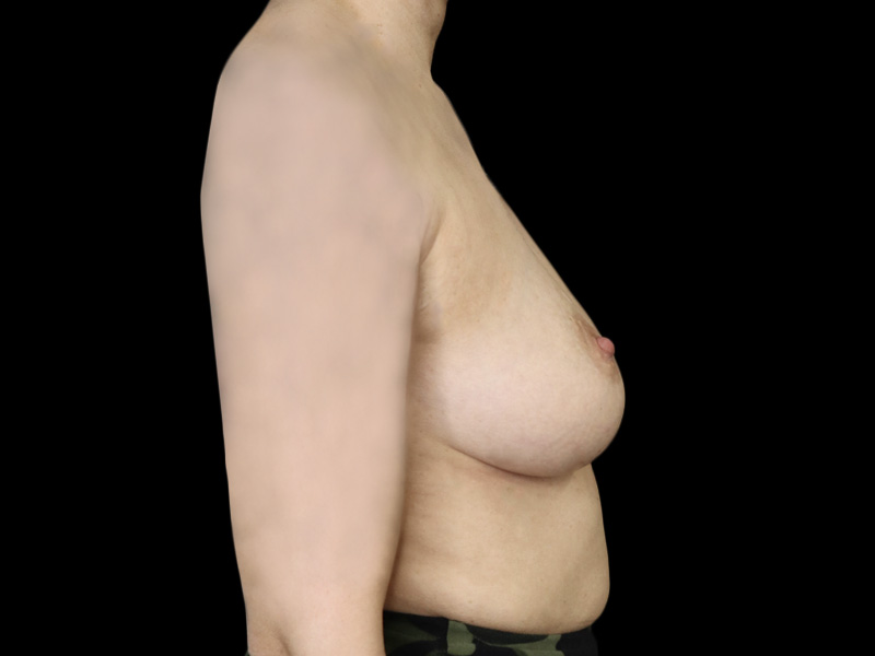 Breast Lift With Implant Patient 8 Lateral Before
