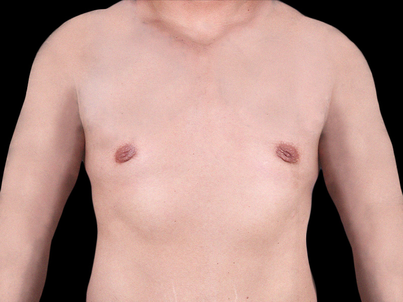 breast-anterior-04.28.2022-33054146-after
