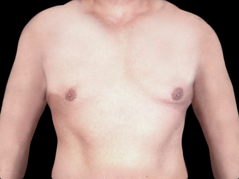 breast-anterior-12.08.2021-27989240-before