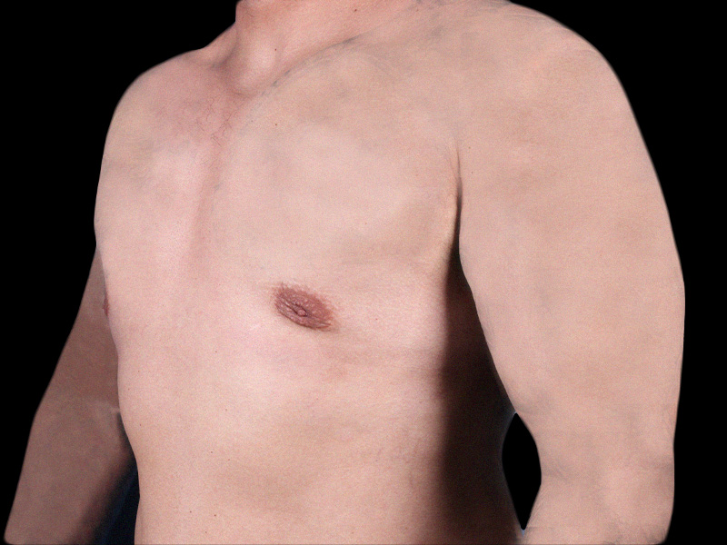 breast-anterior-left-oblique-04.28.2022-33054225-after