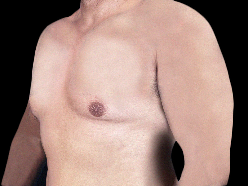 breast-anterior-left-oblique-12.08.2021-27989281-before