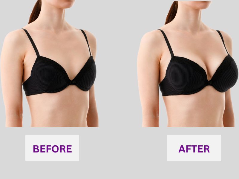 breast implant revision before and after photos