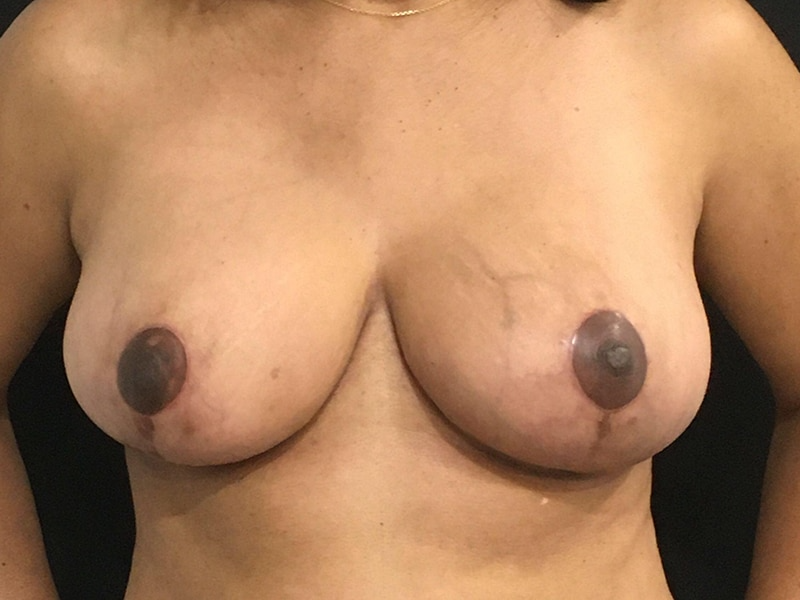 Breast Reduction New Jersey Anterior After