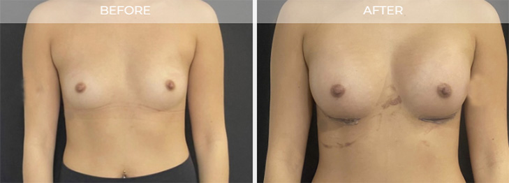 Englewood NJ Breast Augmentation Before and After