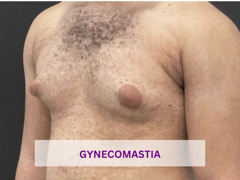 gynecomastia vs chest fat pictures gynecomastia vs chest fat pictures