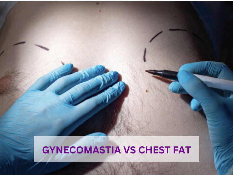 gynecomastia vs chest fat