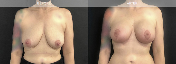 Haddonfield NJ Breast Augmentation