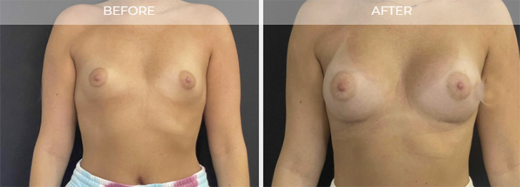 Princeton NJ Breast Implants