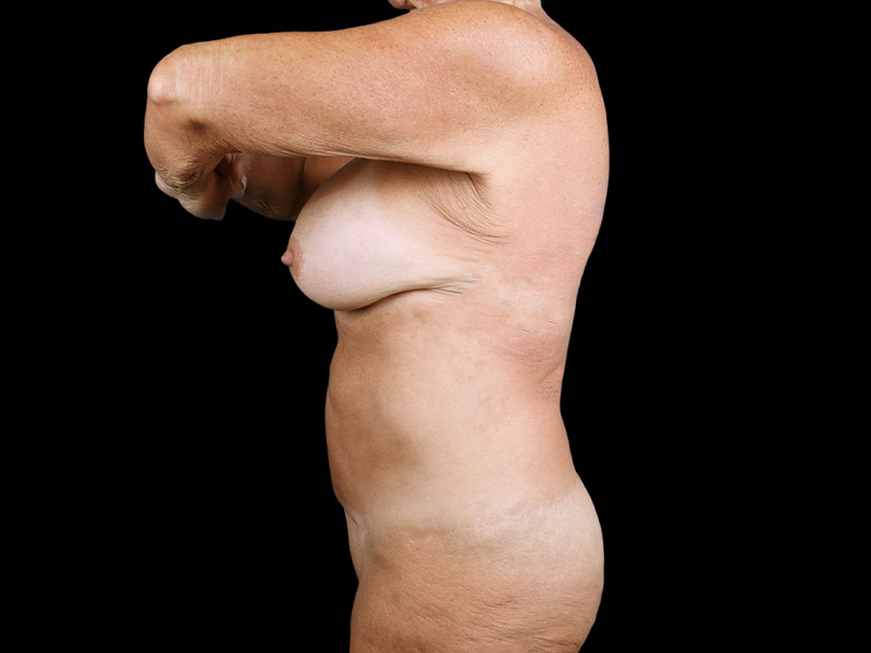 st-bam-lateral-after