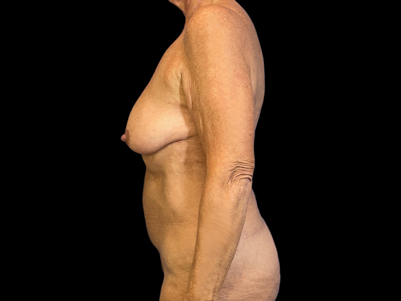 st-bam-lateral-before