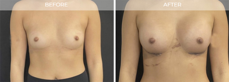 Wayne New Jersey Breast Augmentation Before and After